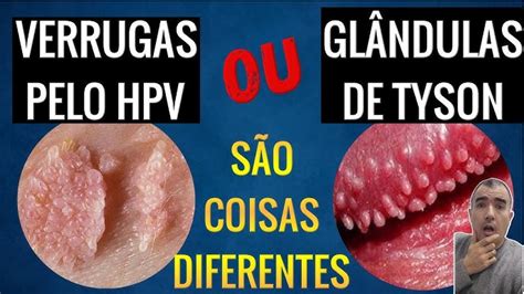 glandulas de tyson ou hpv|Glândulas de Tyson: o que são, porque aparecem e。